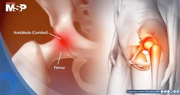 &iquest;Dolor en la cadera? Estas son sus causas, tratamientos y cu&aacute;ndo deber&iacute;a consultar al m&eacute;dico