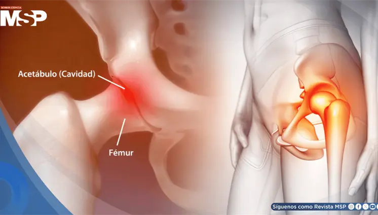 &iquest;Dolor en la cadera? Estas son sus causas, tratamientos y cu&aacute;ndo deber&iacute;a consultar al m&eacute;dico
