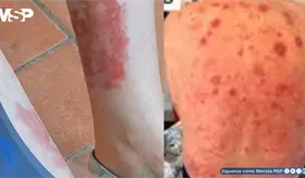 S&iacute;ndrome VEXAS: expertos de la ACR establecen por primera vez criterios para su diagn&oacute;stico y manejo