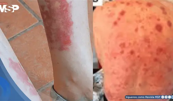 S&iacute;ndrome VEXAS: expertos de la ACR establecen por primera vez criterios para su diagn&oacute;stico y manejo