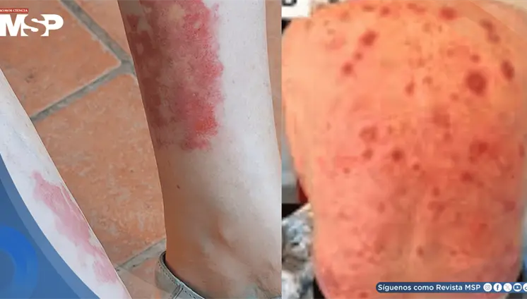 S&iacute;ndrome VEXAS: expertos de la ACR establecen por primera vez criterios para su diagn&oacute;stico y manejo
