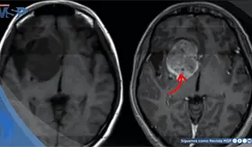 La evolución del papel del oncólogo radioterapeuta en el tratamiento de los gliomas de bajo grado