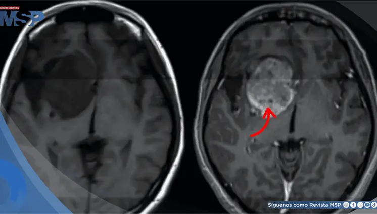 La evoluci&oacute;n del papel del onc&oacute;logo radioterapeuta en el tratamiento de los gliomas de bajo grado