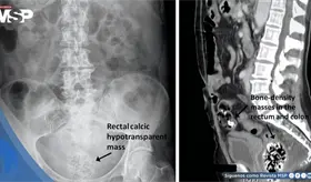 Bezoar rectal masivo provocado por ingesta excesiva de semillas de calabaza en paciente de 39 años