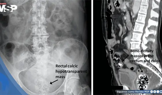 Bezoar rectal masivo provocado por ingesta excesiva de semillas de calabaza en paciente de 39 años