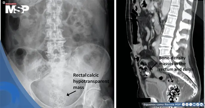 Bezoar rectal masivo provocado por ingesta excesiva de semillas de calabaza en paciente de 39 años Bezoar rectal masivo provocado por ingesta excesiva de semillas de calabaza en paciente de 39 años