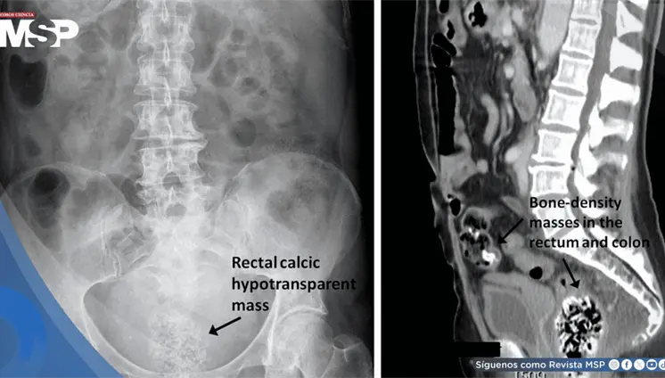 Bezoar rectal masivo provocado por ingesta excesiva de semillas de calabaza en paciente de 39 años Bezoar rectal masivo provocado por ingesta excesiva de semillas de calabaza en paciente de 39 años