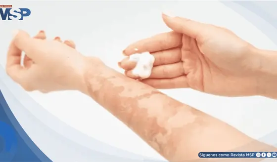 &iquest;Quemaduras en festividades? C&oacute;mo actuar ante emergencias y qu&eacute; productos nunca aplicar sobre la piel