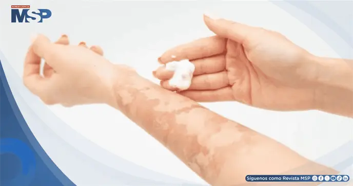 ¿Quemaduras en festividades? Cómo actuar ante emergencias y qué productos nunca aplicar sobre la piel