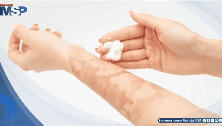 ¿Quemaduras en festividades? Cómo actuar ante emergencias y qué productos nunca aplicar sobre la piel ¿Quemaduras en festividades? Cómo actuar ante emergencias y qué productos nunca aplicar sobre la piel