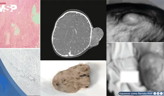 Masa en el cuero cabelludo de un bebé prematuro resultó ser un tumor rabdoide extracraneal
