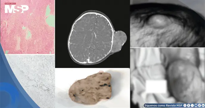 Masa en el cuero cabelludo de un bebé prematuro resultó ser un tumor rabdoide extracraneal Masa en el cuero cabelludo de un bebé prematuro resultó ser un tumor rabdoide extracraneal