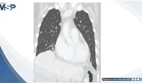 Taponamiento card&iacute;aco como manifestaci&oacute;n inicial de recurrencia tard&iacute;a de melanoma maligno