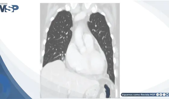 Taponamiento card&iacute;aco como manifestaci&oacute;n inicial de recurrencia tard&iacute;a de melanoma maligno