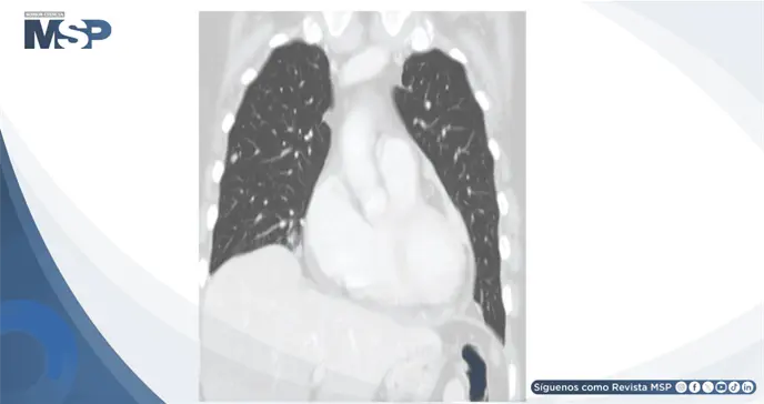 Taponamiento cardíaco como manifestación inicial de recurrencia tardía de melanoma maligno Taponamiento cardíaco como manifestación inicial de recurrencia tardía de melanoma maligno