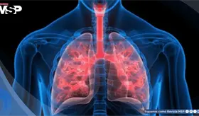 Explican la raz&oacute;n del rechazo cr&oacute;nico de trasplante de pulm&oacute;n: Interacci&oacute;n celular provocar&iacute;a inflamaci&oacute;n