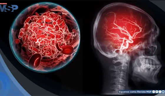 El cerebro escucha, pero no procesa de la misma forma: as&iacute; afecta un ictus la comprensi&oacute;n del habla
