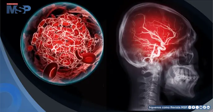 El cerebro escucha, pero no procesa de la misma forma: as&iacute; afecta un ictus la comprensi&oacute;n del habla