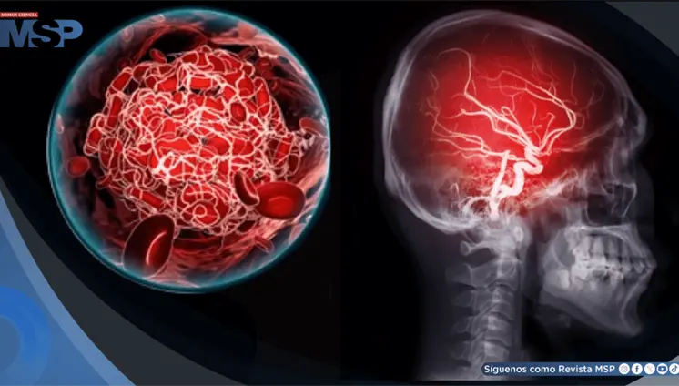 El cerebro escucha, pero no procesa de la misma forma: así afecta un ictus la comprensión del habla El cerebro escucha, pero no procesa de la misma forma: así afecta un ictus la comprensión del habla