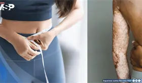 P&eacute;rdida de peso mejora significativamente la psoriasis y calidad de vida de los pacientes: Estudio