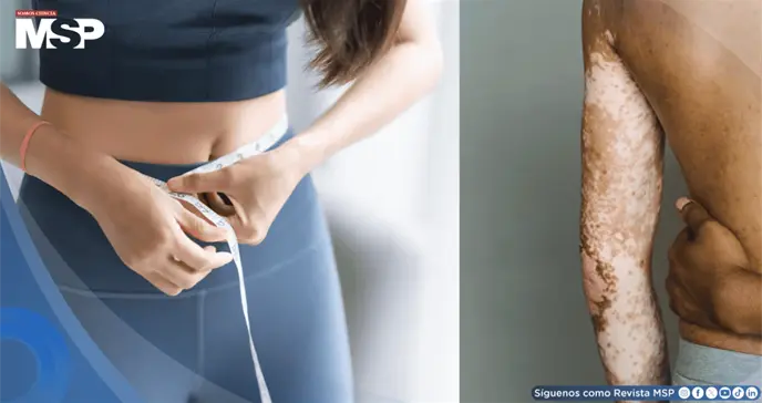 P&eacute;rdida de peso mejora significativamente la psoriasis y calidad de vida de los pacientes: Estudio