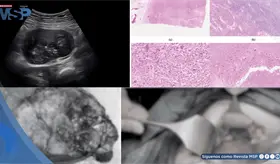 Masa abdominal en gestante: Sarcoma dendr&iacute;tico folicular y Castleman con restricci&oacute;n de crecimiento fetal