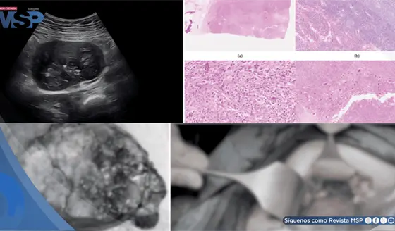 Masa abdominal en gestante: Sarcoma dendr&iacute;tico folicular y Castleman con restricci&oacute;n de crecimiento fetal