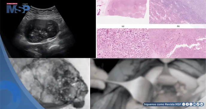 Masa abdominal en gestante: Sarcoma dendr&iacute;tico folicular y Castleman con restricci&oacute;n de crecimiento fetal