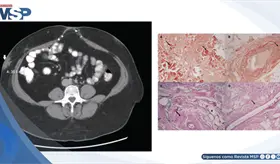 Masa abdominal en paciente de 40 a&ntilde;os es causada por amiloidosis derivada de inyecciones de insulina
