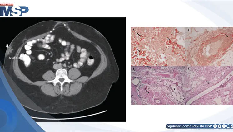 Masa abdominal en paciente de 40 años es causada por amiloidosis derivada de inyecciones de insulina Masa abdominal en paciente de 40 años es causada por amiloidosis derivada de inyecciones de insulina
