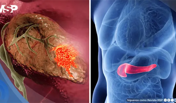 Piel amarillenta, orina oscura y p&eacute;rdida de peso: As&iacute; podr&iacute;a reconocer el c&aacute;ncer de p&aacute;ncreas
