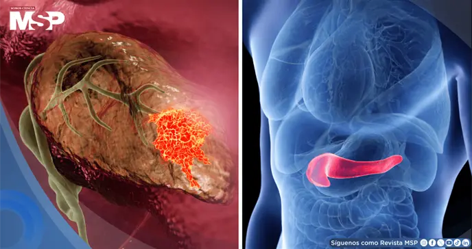 Piel amarillenta, orina oscura y p&eacute;rdida de peso: As&iacute; podr&iacute;a reconocer el c&aacute;ncer de p&aacute;ncreas