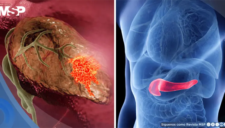 Piel amarillenta, orina oscura y p&eacute;rdida de peso: As&iacute; podr&iacute;a reconocer el c&aacute;ncer de p&aacute;ncreas