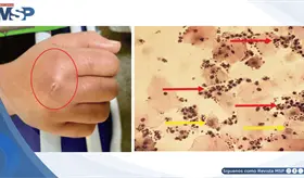 Infecci&oacute;n de tejidos blandos por Candida albicans asociada a administraci&oacute;n prolongada de betametasona