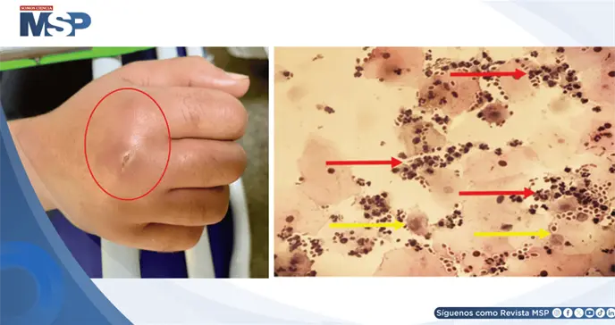 Infecci&oacute;n de tejidos blandos por Candida albicans asociada a administraci&oacute;n prolongada de betametasona