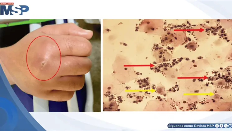 Infecci&oacute;n de tejidos blandos por Candida albicans asociada a administraci&oacute;n prolongada de betametasona