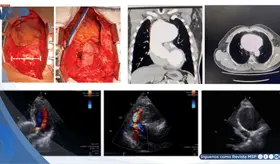 Reportan el aneurisma a&oacute;rtico sifil&iacute;tico m&aacute;s grande en d&eacute;cadas en paciente de 59 a&ntilde;os