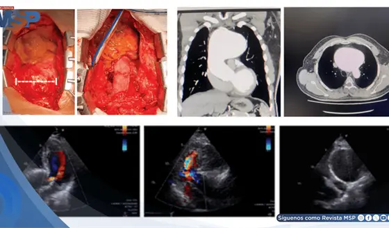 Reportan el aneurisma a&oacute;rtico sifil&iacute;tico m&aacute;s grande en d&eacute;cadas en paciente de 59 a&ntilde;os