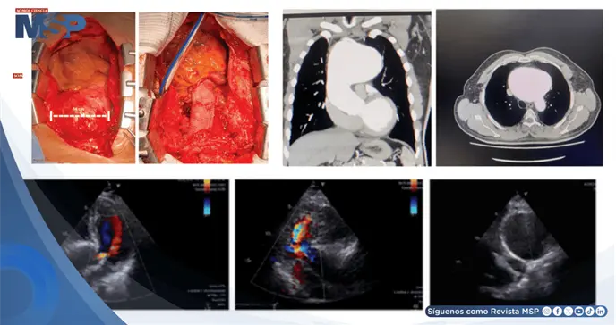 Reportan el aneurisma a&oacute;rtico sifil&iacute;tico m&aacute;s grande en d&eacute;cadas en paciente de 59 a&ntilde;os