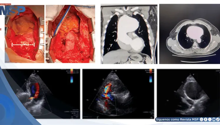Reportan el aneurisma aórtico sifilítico más grande en décadas en paciente de 59 años Reportan el aneurisma aórtico sifilítico más grande en décadas en paciente de 59 años