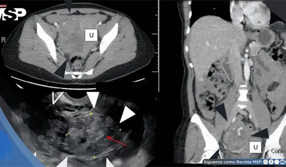 Rotura ov&aacute;rica por embarazo ect&oacute;pico fue confundida con c&aacute;ncer en una mujer con ascitis y masa abdominal