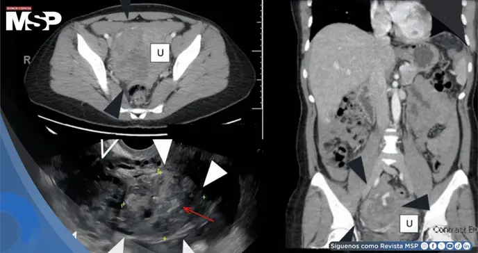 Rotura ovárica por embarazo ectópico fue confundida con cáncer en una mujer con ascitis y masa abdominal Rotura ovárica por embarazo ectópico fue confundida con cáncer en una mujer con ascitis y masa abdominal