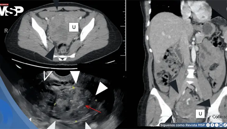 Rotura ovárica por embarazo ectópico fue confundida con cáncer en una mujer con ascitis y masa abdominal Rotura ovárica por embarazo ectópico fue confundida con cáncer en una mujer con ascitis y masa abdominal