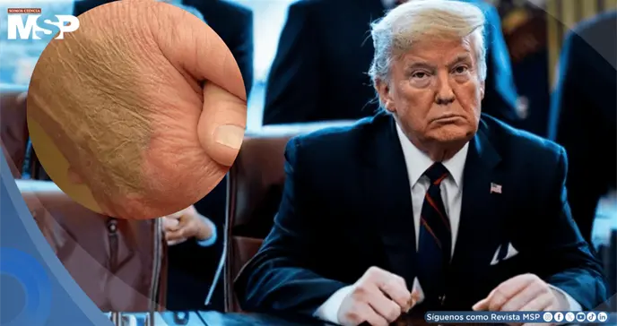 Hematomas, somnolencia y test cognitivo: lo que se sabe de la salud de Trump como presidente más longevo Hematomas, somnolencia y test cognitivo: lo que se sabe de la salud de Trump como presidente más longevo