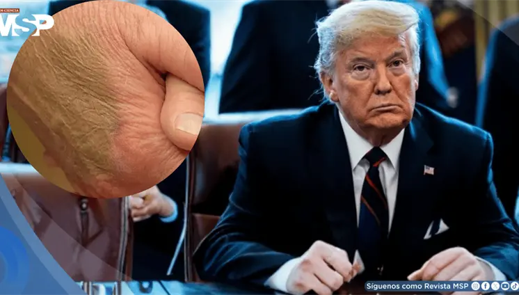 Hematomas, somnolencia y test cognitivo: lo que se sabe de la salud de Trump como presidente más longevo Hematomas, somnolencia y test cognitivo: lo que se sabe de la salud de Trump como presidente más longevo