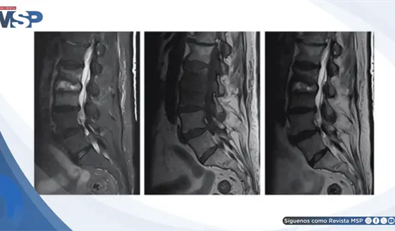 Diagnostican osteomielitis vertebral por SARM tras taponamiento nasal en paciente anticoagulada