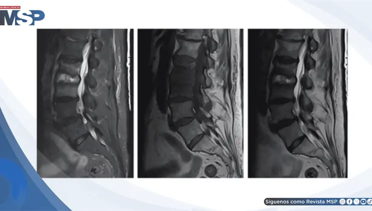 Diagnostican osteomielitis vertebral por SARM tras taponamiento nasal en paciente anticoagulada