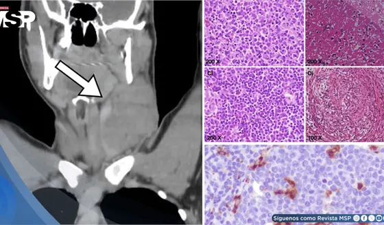 Masa cervical en var&oacute;n de 17 a&ntilde;os es causada por linfadenitis histioc&iacute;tica necrotizante tipo Kikuchi-Fuji