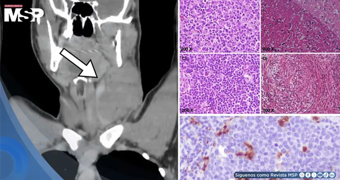 Masa cervical en var&oacute;n de 17 a&ntilde;os es causada por linfadenitis histioc&iacute;tica necrotizante tipo Kikuchi-Fuji