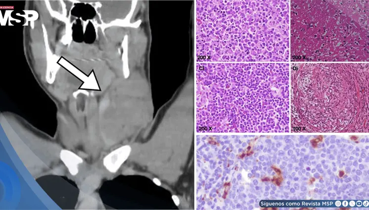 Masa cervical en varón de 17 años es causada por linfadenitis histiocítica necrotizante tipo Kikuchi-Fuji Masa cervical en varón de 17 años es causada por linfadenitis histiocítica necrotizante tipo Kikuchi-Fuji